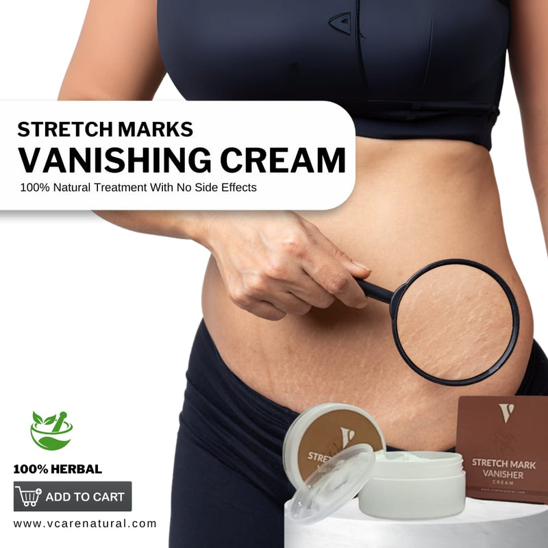 Stretch Mark Vanishing Cream