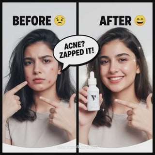 VCARE Natural Acne Serum 30ml video for oily, acne-prone skin in Pakistan showing product use and clearer-looking balanced skin.ایکنی کیئر سیرم - 30ml