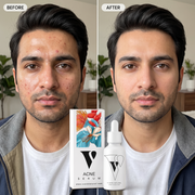 VCARE Natural Acne Serum 30ml before and after UGC with Pakistani man showing clearer-looking balanced skinایکنی کیئر سیرم - 30ml