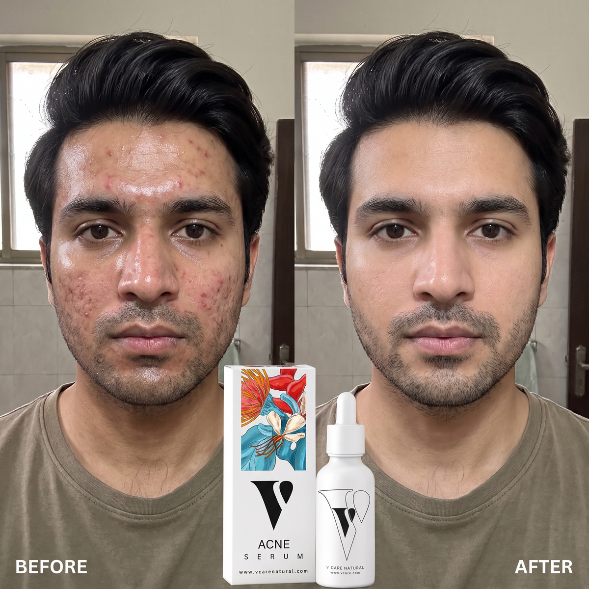 VCARE Natural Acne Serum 30ml before and after UGC with Pakistani man showing clearer-looking balanced skin
