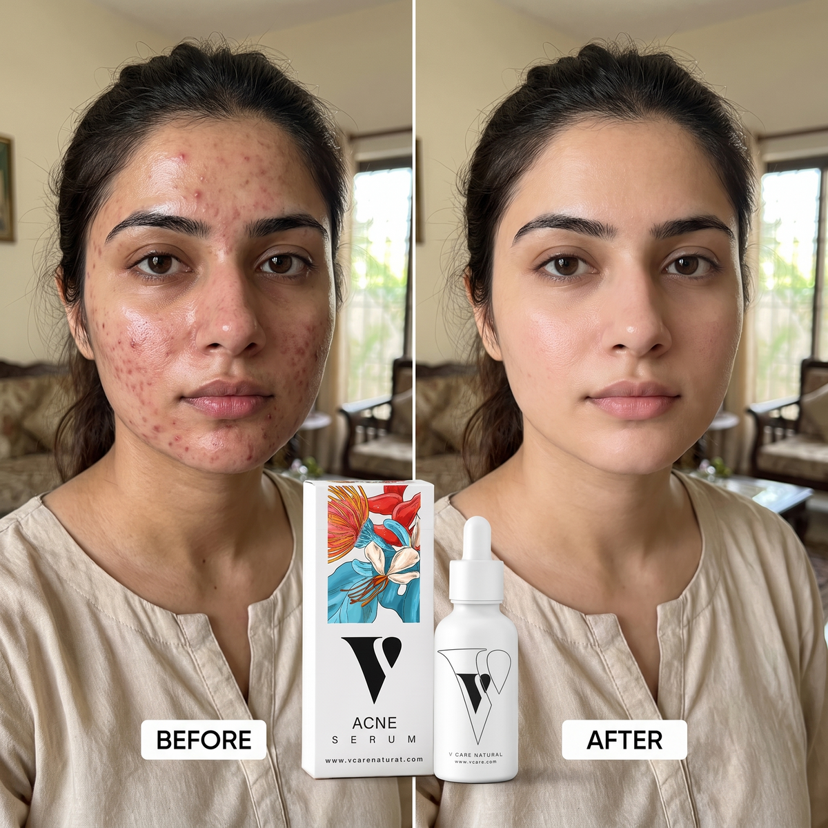 VCARE Natural Acne Serum 30ml before and after UGC with Pakistani woman showing clearer-looking balanced skin