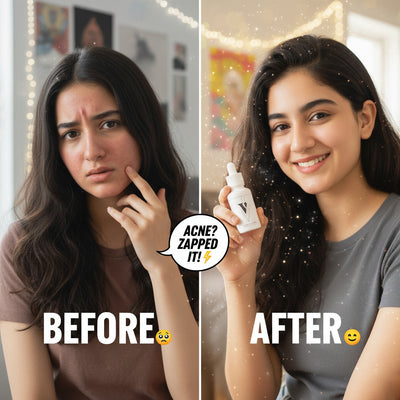 VCARE NATURAL Acne Serum - product view 1