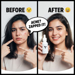 Lightweight acne control serum texture results before after