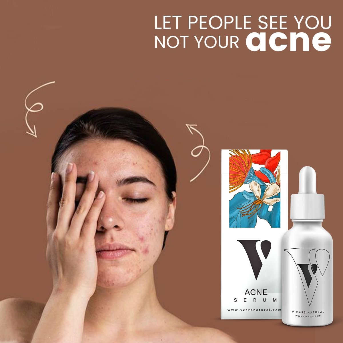 Acne Serum - Vcare Natural